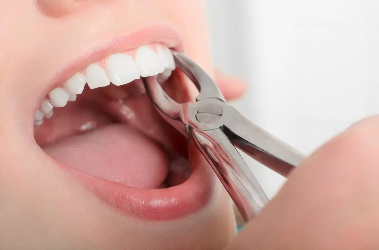 Come rimuovere il tartaro rapidamente con un rimedio naturale approvato dai dentisti Immagine selezionata